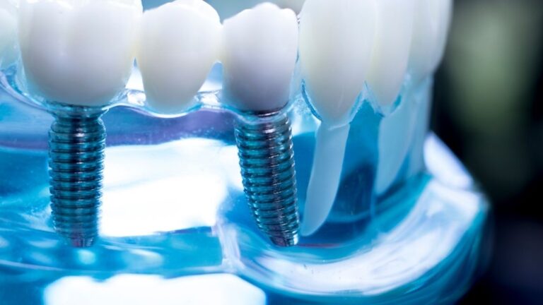 3D Printing in Dental Implantology